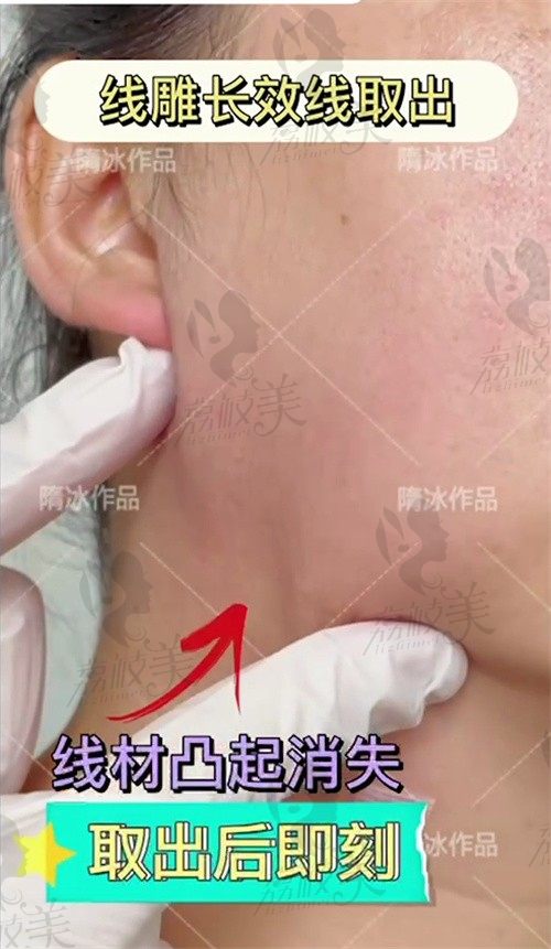 北京苏亚埋线提升面部长效线修复手术，术后恢复情况怎么样？