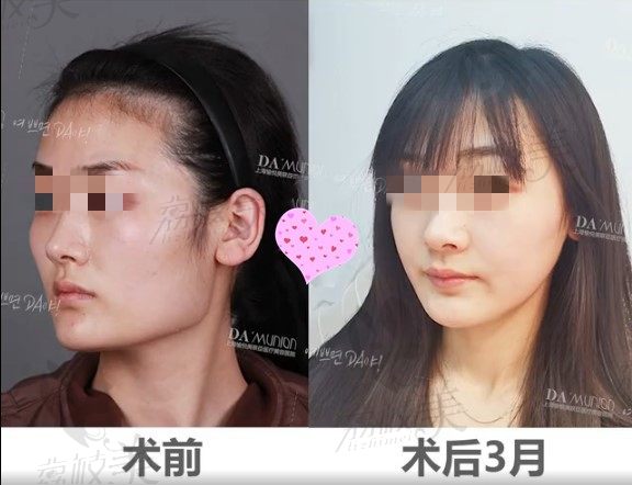 上海美联臣的曹栋弼磨骨怎么样？找他做完颧骨内推和下颌角好后悔！
