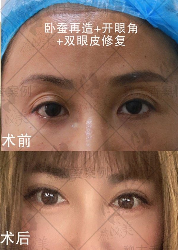 北京眼修复医院哪家好？北京丽星翼美和丰联丽格眼修复效果图及价格参考