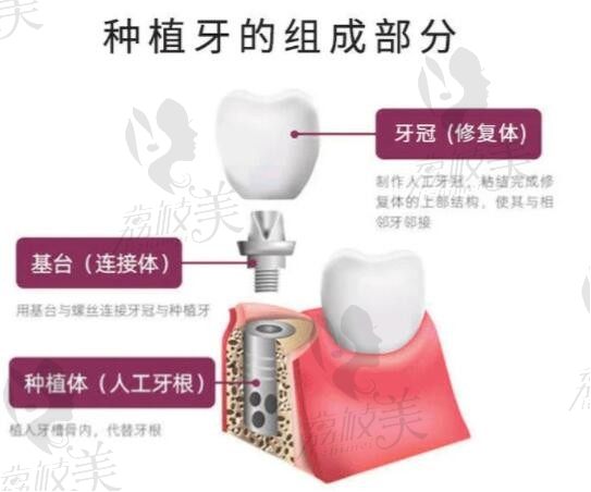 想了解上海哪家医院种植牙齿比较好？上海松丰口腔门诊部怎么样？