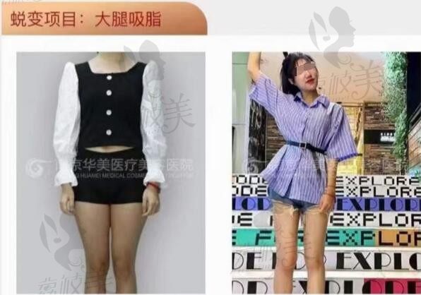 想了解南京哪里抽脂比较好？可参考南京华美5g天使光雕吸脂价格和效果。