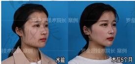 北京联合丽格做颧骨缩小长曲线下颌角怎么样？何照华和罗金超哪个磨骨技术好，多少钱
