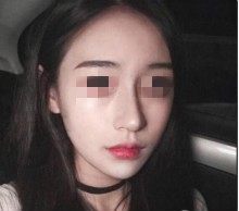 河南中医药附属医院下颌角磨骨术后两个月恢复过程，肿胀轻恢复快！