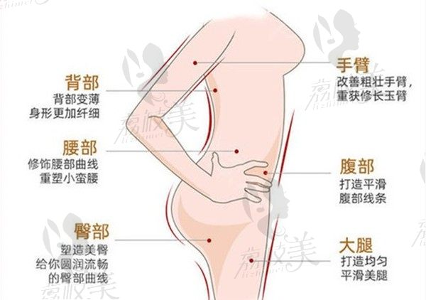 哈尔滨吸脂哪个医院做的好?整友推荐的艺星整形全身吸脂好吗?贵吗?