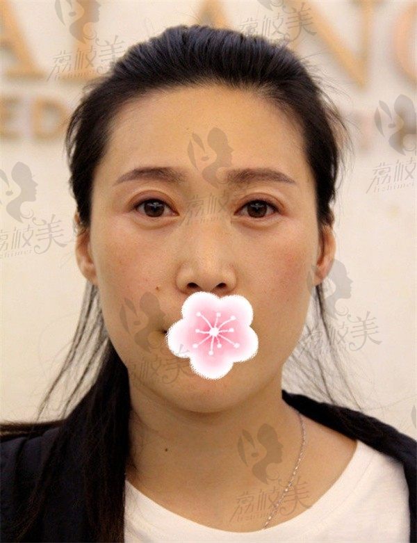 北京穆宝安拉皮案例分享：陈女士拉皮术后30天面部轮廓线条清晰