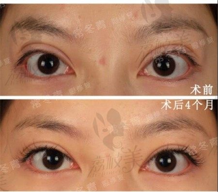 北京双眼皮医生排行榜，最新北京修复双眼皮医生的十大排名
