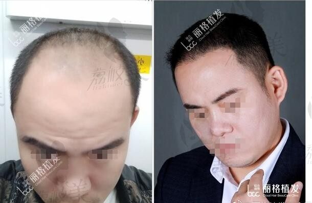 北京植发医院哪家医技术好？为啥发友说丽格植发还挺正规和靠谱的。