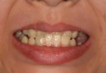 13孩子牙齿下牙包住上牙，想了解昆明美奥口腔做儿童牙齿矫正怎么样？