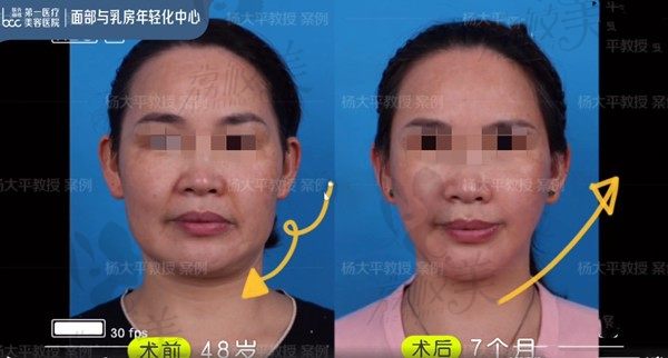 杨大平拉皮案例,面部提升费用6万多手术成效好减龄很明显