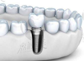 牙齿松动有什么办法修复吗?修复时镶牙好还是直接种牙好？