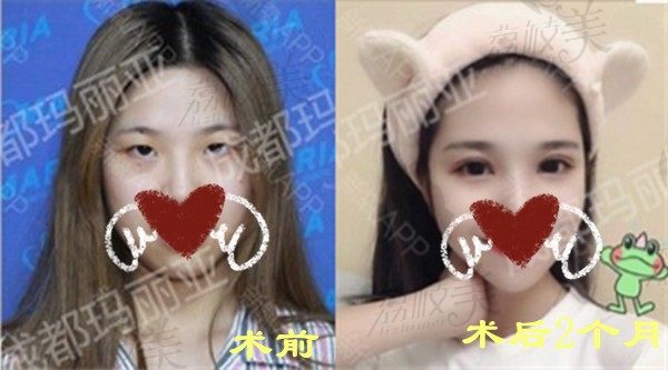成都玛丽亚王建平切开双眼皮＋内外眼角术后效果图看这个眼综合做的值不值