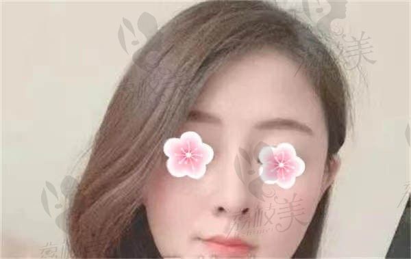 想要金孝宪隆鼻效果的宝快看，我在广州紫馨整形做完肋骨隆鼻的详细记录分享