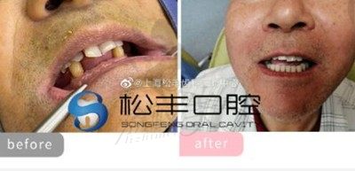 公布上海十大种植牙医院排名，排行前五的私立口腔医院便宜还好