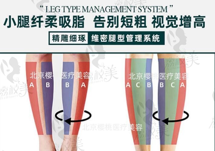 北京樱桃医疗美容齐永乐双平行直腿术=吸脂＋塑形+填充，精雕细琢轻松告别短粗腿