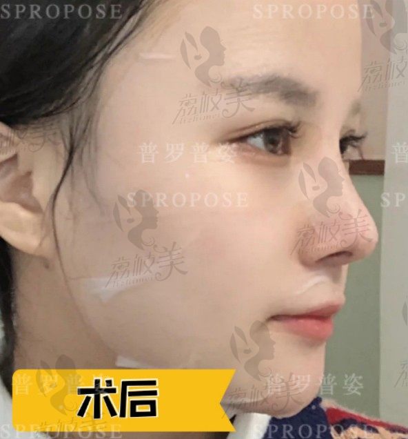 南京原韩金志昱的鼻综合效果有多好，术后效果图告诉你金医生的实力