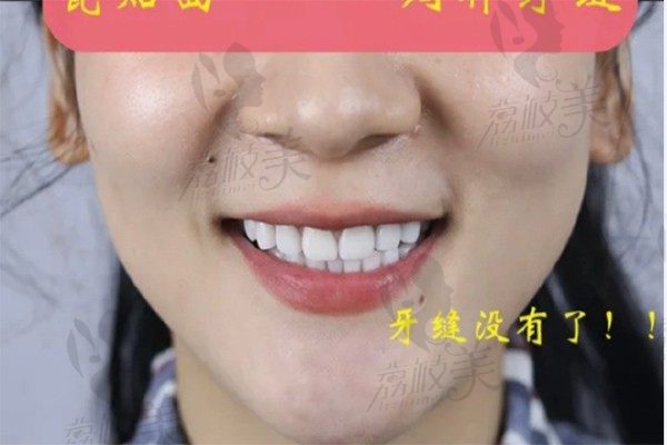 找武汉壹加口腔的李胜锐做超薄瓷贴面，轻松解决牙齿稀松的苦恼