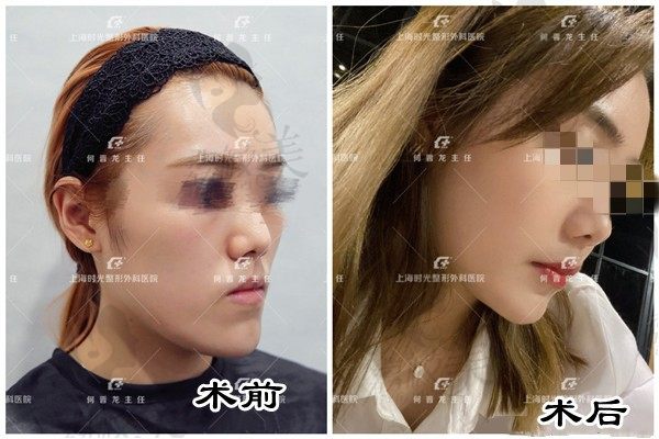 惊！大批量地包天、歪脸在上海时光找何晋龙院长做的正颌正畸术前术后效果来袭