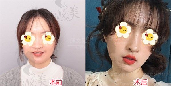 看了上海伊莱美邱文苑做的膨体+肋软骨隆鼻术前术后对比图集锦,很普通吗？