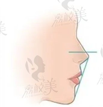 正颌和正畸有什么区别，成人地包天矫正能对脸型有所改善吗？
