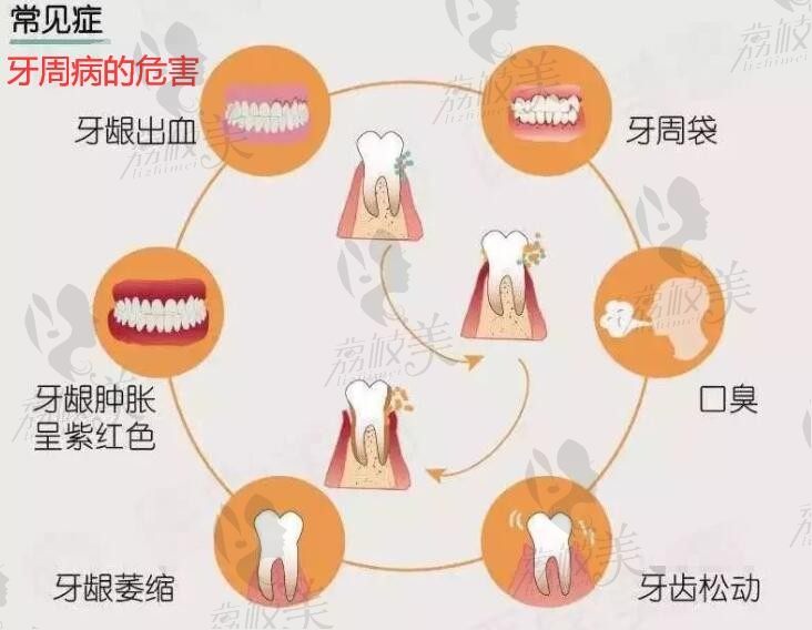 牙周病是什么原因引起的？危害大不？列举牙周病的误区！