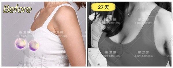 上海华美特贝茨双平面隆胸术谢卫国亲诊,不引流不出血术后可增大三个罩杯