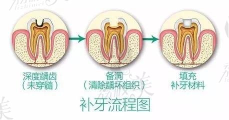 牙齿缺损、有龋齿，不治疗问题大吗？揭秘不及时治疗龋齿，将带来的后果！！