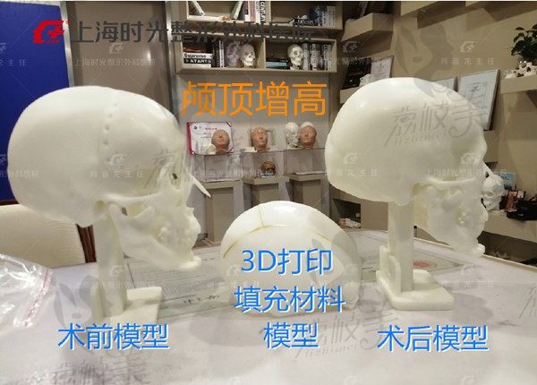 扁头填充手术在国内哪能做？上海时光何晋龙做填充颅顶和后脑勺靠谱吗？