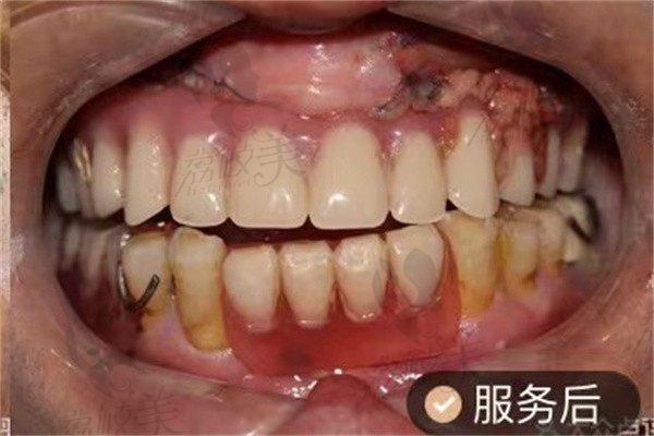 患者多颗牙缺失修复，重庆牙博士做美国登腾种植牙六颗，咀嚼无压力