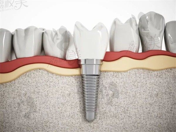 缺牙后，修复方式有几种？为啥医生更建议种植牙修复？
