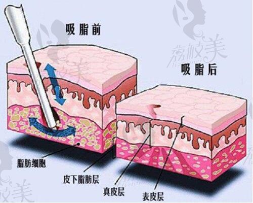 2021年南京全身吸脂價(jià)格公布，還有技術(shù)好的醫(yī)院分享，來看你需要多少錢的吧！