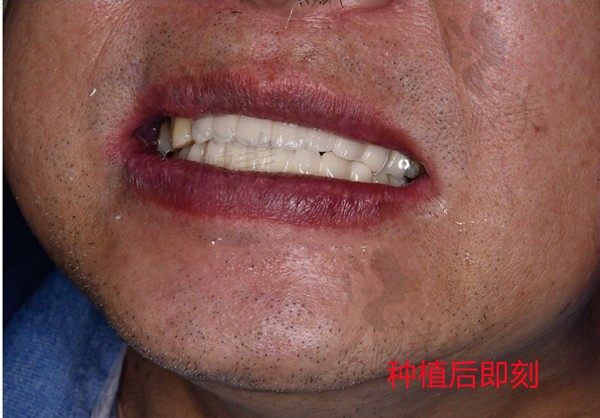大批量上海松丰全口种植牙恢复图来袭，各位牙友的种植经验分享~