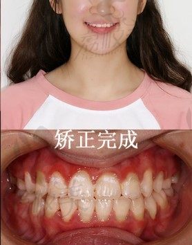 比起正畸的痛,我在东莞固德口腔做的金属矫正牙齿,颜值提升更划算