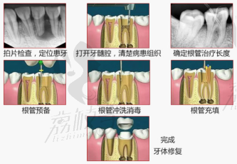 北京钛植口腔显微镜根管治疗，保住真牙告别牙齿痛！
