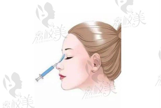 武汉美莱贺建平医生做面部微整形怎么样，玻尿酸隆鼻技术好吗？