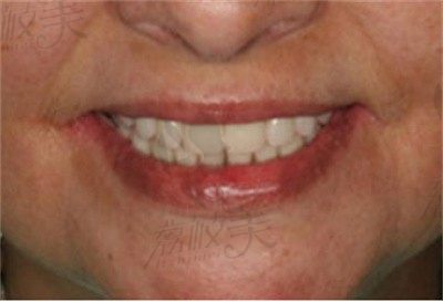 厦门麦芽口腔陈海滨ALL-ON-4种植牙技术，半口/全口牙缺失的有效治疗方案