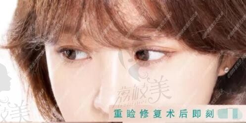 坐标北京修复双眼皮好的医生，刘风卓修复双眼皮口碑怎么样？