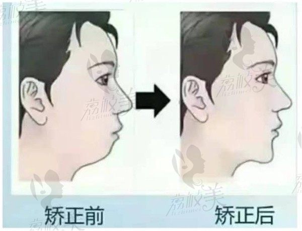 儿童错颌畸形高怎么预防，