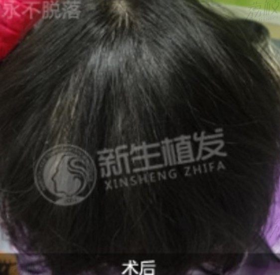 头上有疤痕不长头发怎么办，北京新生植发疤痕种植持久自然