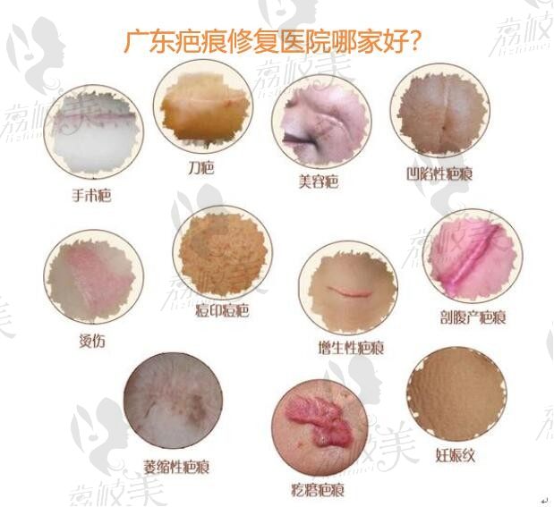 更新广州去疤痕医院排名，来看疤痕修复医院哪家比较好