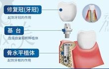 杭州各大口腔医院种牙费用,种植牙公立私立悬殊大吗?
