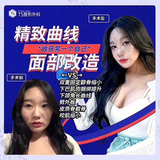 TS整形——轮廓手术从术前到恢复期，真实记录我的变化!