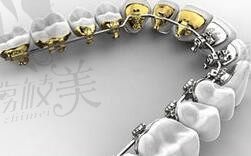 杭州牙齿矫正医院推荐,内含杭州舌侧矫正医生名单和价格