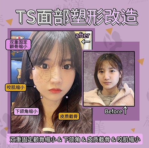 TS整形外科，面部塑形让我元气满满、自信满满。