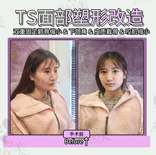 手术前