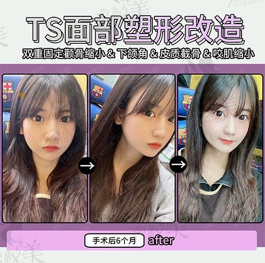 手术后