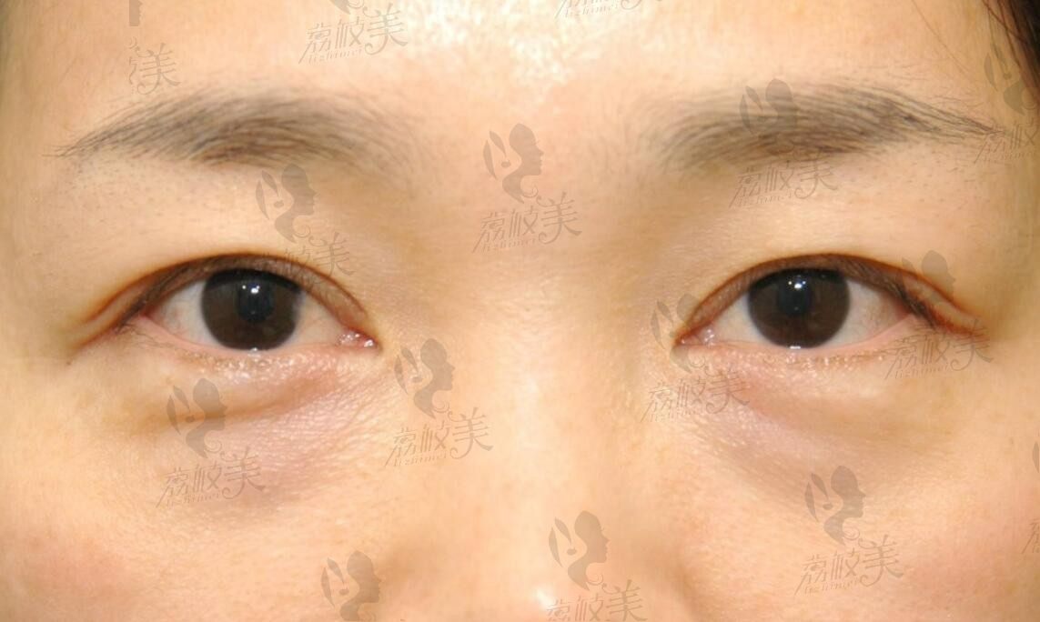 魏志香高难度眼睛修复真心不错，看魏志香院长祛眼袋+眼修复手术分享