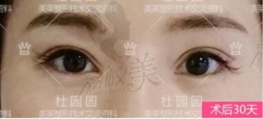 上海双眼皮修复谁厉害？杜园园修复双眼皮怎么样？