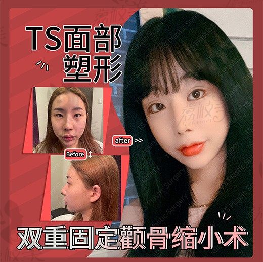 TS整形外科，我做了双重固定颧骨缩小手术，面容流畅萌萌哒！