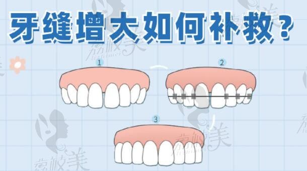 牙齿缝隙大怎么办?该如何进行修复，选牙齿矫正还是贴面？