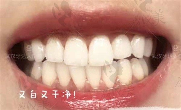 武汉牙达人口腔是正规的二级口腔医院，种植牙性价比还高